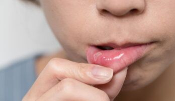 Bolestivé afty v ústach môžu odrážať nedostatok vitamínov. Ako sa ich zbaviť?