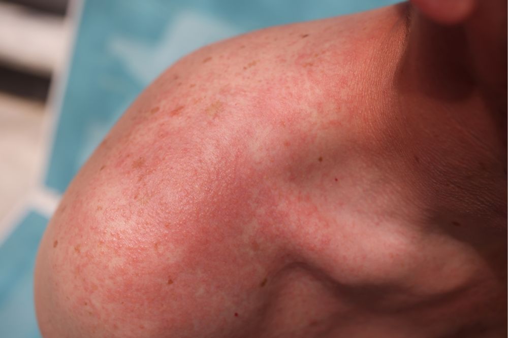 Pohľad na začervenanú pokožku na ramene v dôsledku UV žiarenia a alergie na slnko.