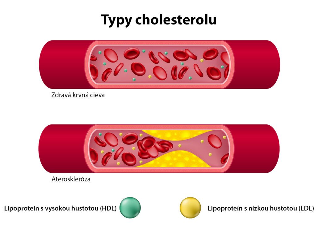 Obrázok zobrazuje typy cholesterolu HDL a LDL a tiež ako vyzerá zdravá krvná cieva a cieva s aterosklerózou.