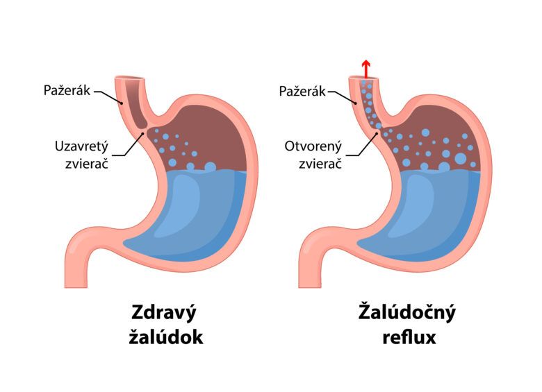 Porovnanie zdravého žalúdka a žáludka v ktorom prebieha pálenie záhy a žalúdočný reflux.