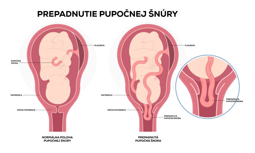 Infografika zobrazujúca prepadnutie pupočnej šnúry, čo je komplikácia, kedy pupočná šnúra prekáža pri pôrode.