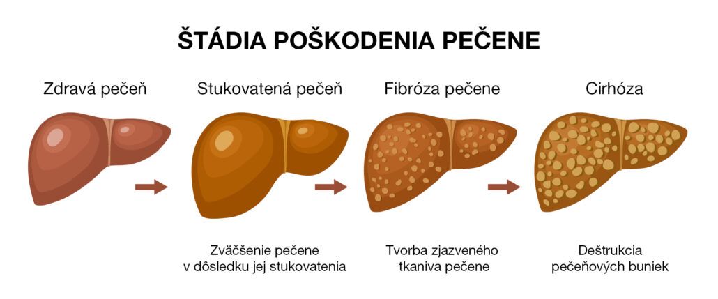 Štádia poškodenia pečene: zdravá pečeň, stukovatená pečeň, fibróza, cirhóza.