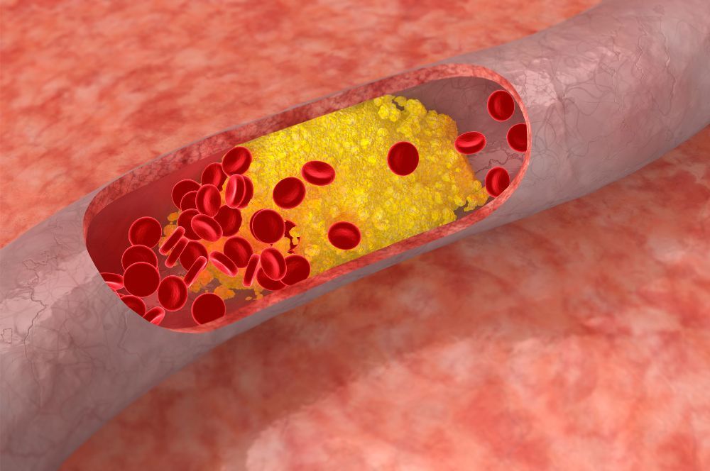 Obrázok zobrazuje vysoký cholesterol v cievach na ktorého liečbu sa používajú statíny.