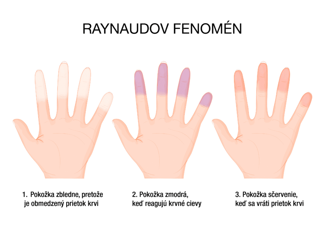 Infografika zobrazuje raynaudov fenomén, čo je neškodný stav, keď sa drobné cievy v prstoch reflexne stiahnu pri kontakte s chladom alebo stresom.