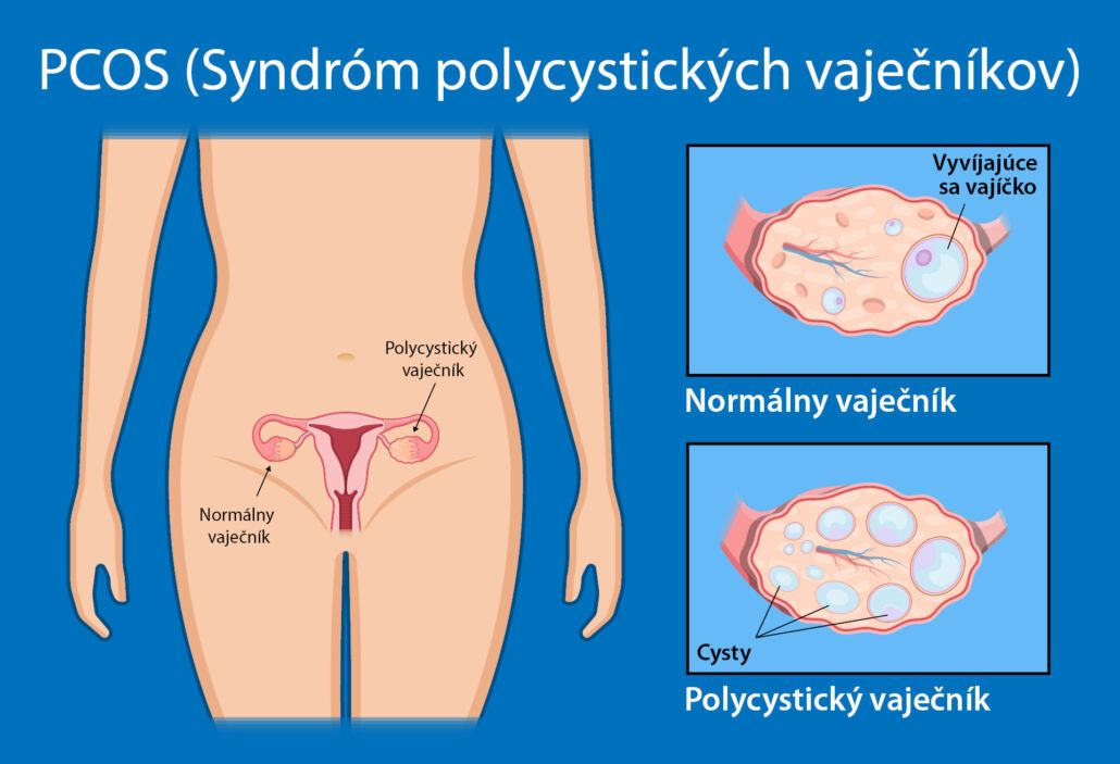 Rozdiel medzi zdravých a polycystickým vaječníkom.