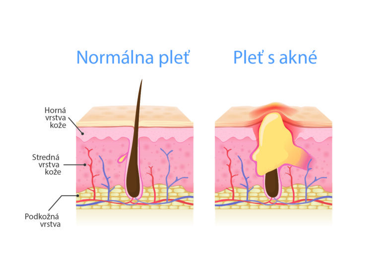 Porovnanie normálne pleti a pleti s akné, ktoré spôsobujú hormóny, ktoré ovplyvňujú kvalitu pleti.