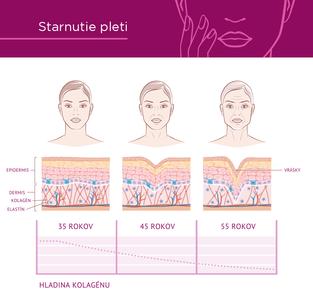 Infografika o starnutí pletí v dôsledku zníženia hladiny kolagénu.