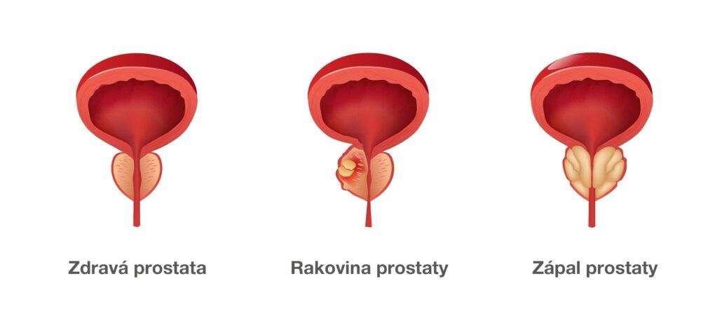 Zdravá prostata, Rakovina prostaty, Zápal prostaty.