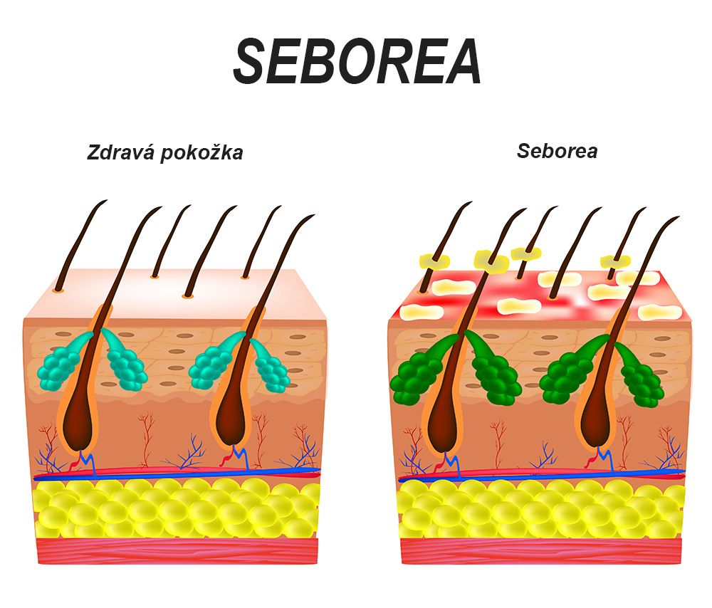 Porovnanie zdravej pokožky hlavy s pokožkou hlavy so seboreou, ktorá je zapálená a vlasy sa rýchlo mastia.