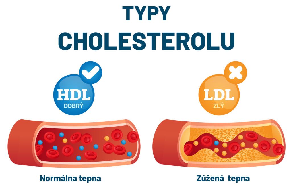 Infografika, ktorá zobrazuje typy cholesterolu HDL, ktorý označujeme ako dobrý cholesterol a LDL, ktorý označujeme ako zlý a s jeho znižovaním pomáhajú statíny.