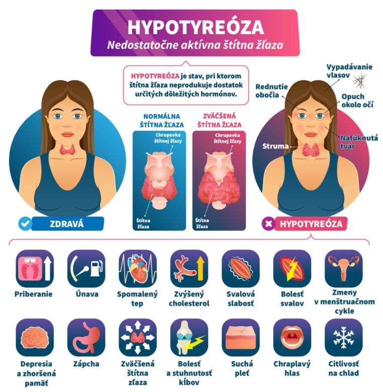 Infografika o hypotyreóze, pri ktorej štítna žľaza neprodukuje dostatočné množstvo určitých hormónov.