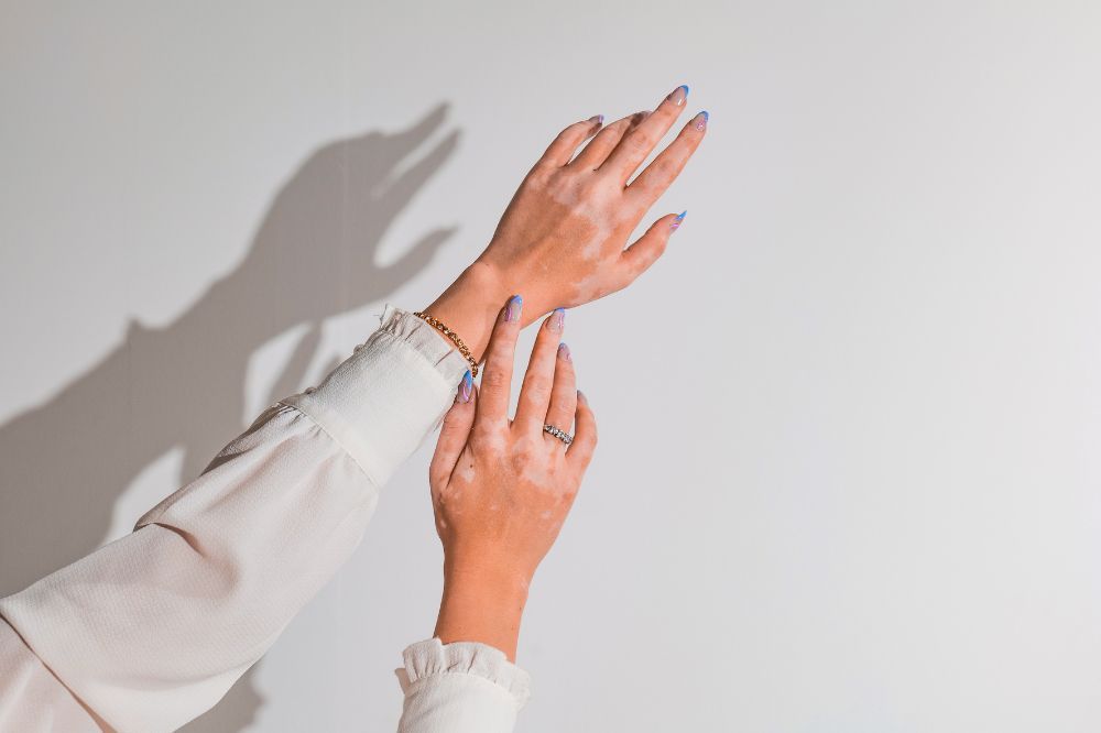 Pohľad na ruky mladej ženy, ktorá trpí vitiligom a rozhodla sa pre liečbu.