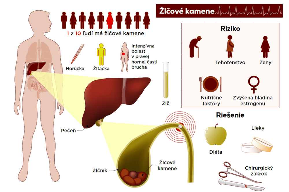 Infografika zobrazuje, kde sa usádzajú žlčové kamene a aké sú príznaky žlčových kameňov: žltačka, horúčka, bolesť.