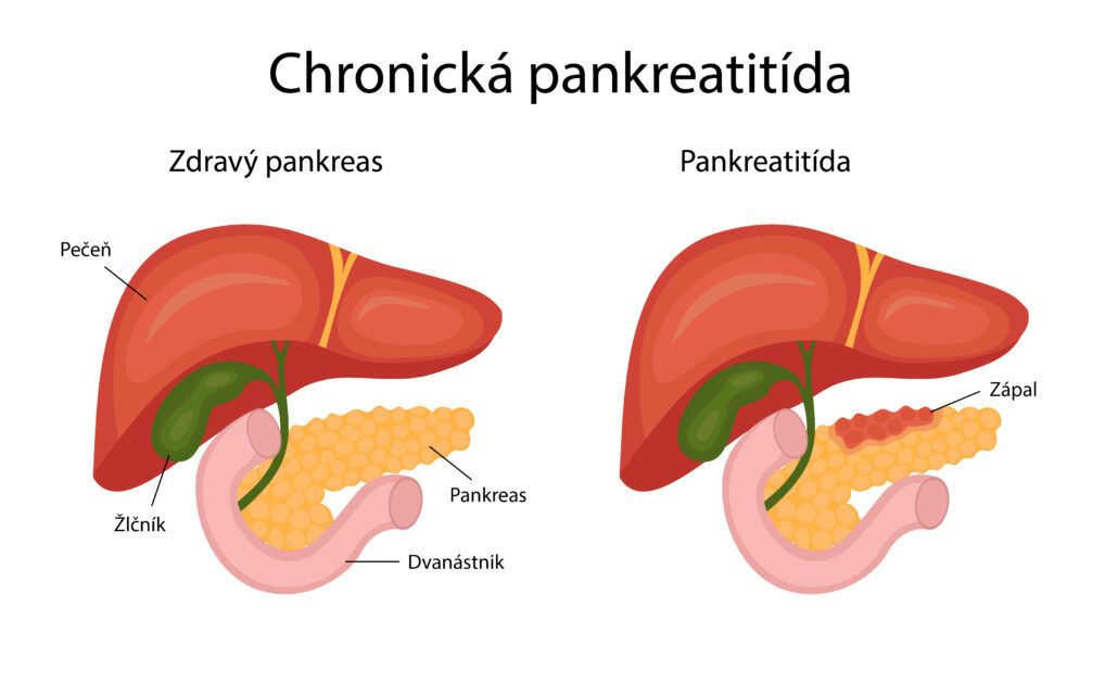 Infografika, ktorá zobrazuje zdravý pankreas a pankreas s chronickou pankreatitídou.