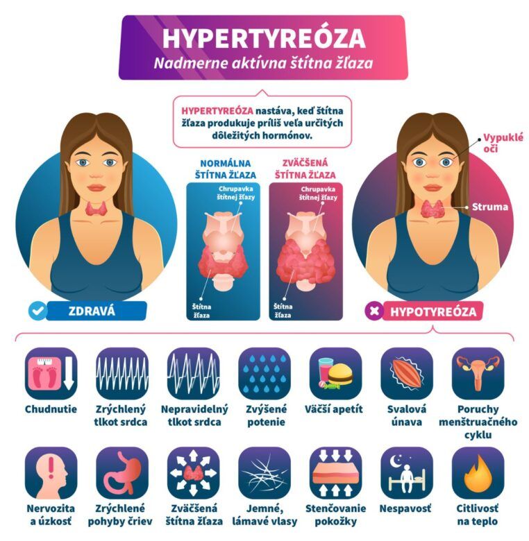 Infografika o hypotyreóze, pri ktorej štítna žľaza produkuje nadmerné množstvo určitých hormónov.