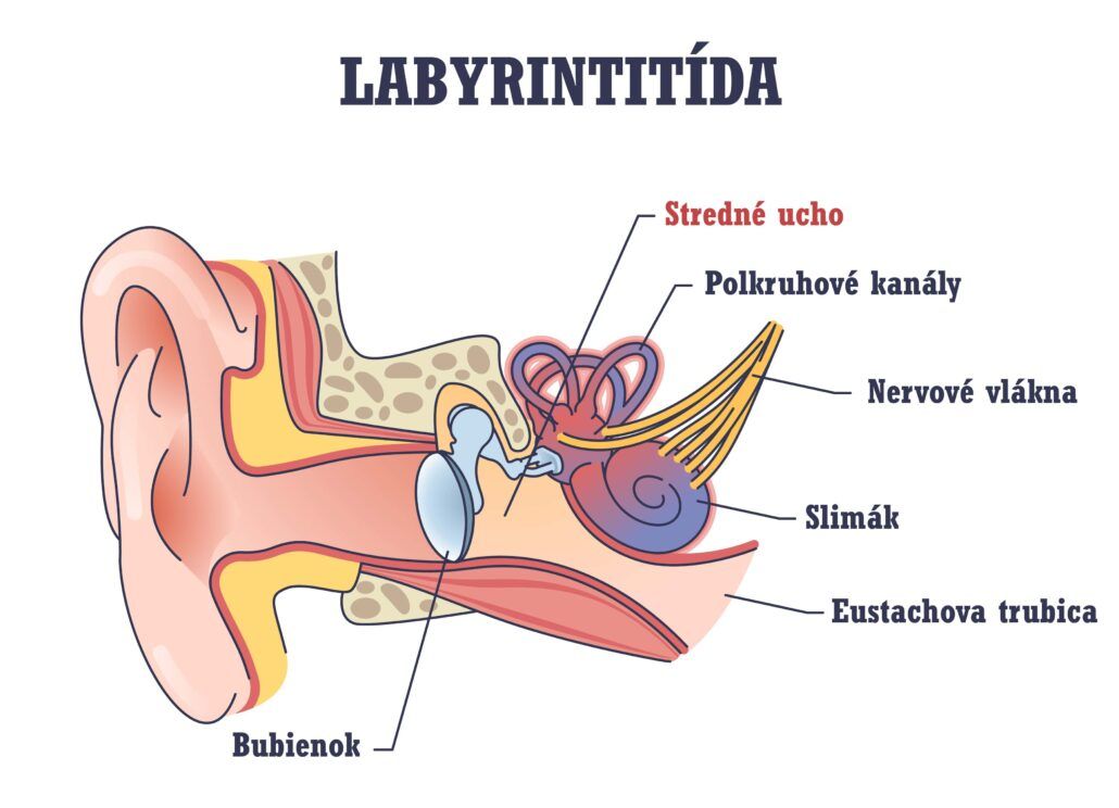 Infografika o labyrintitíde, ktorá patrí medzi choroby s príznakmi poruchy rovnováhy a sprievodným symptómom môže byť aj zaľahnutie v uchu.