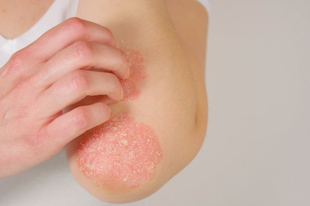 Pohľad na ruku, ktorá škriabe škaredé červené ložiska na lakti, ktoré sú spôsobené autoimunitným ochorením známym ako psoriáza.