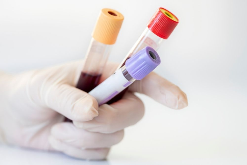 Vysoké hodnoty biotínu - vyšetrenie krvi. Ruka držiaca skúmavky s krvou.