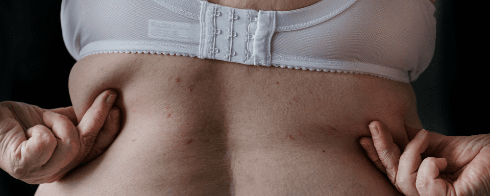 Žena si drží tukové záhyby na chrbte, pretože má väčší obvod pása, čo je dôsledok zmien metabolizmu v menopauze